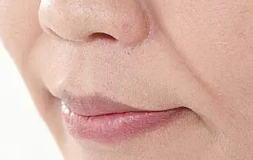 海口打玻尿酸可以改善鼻唇沟吗？